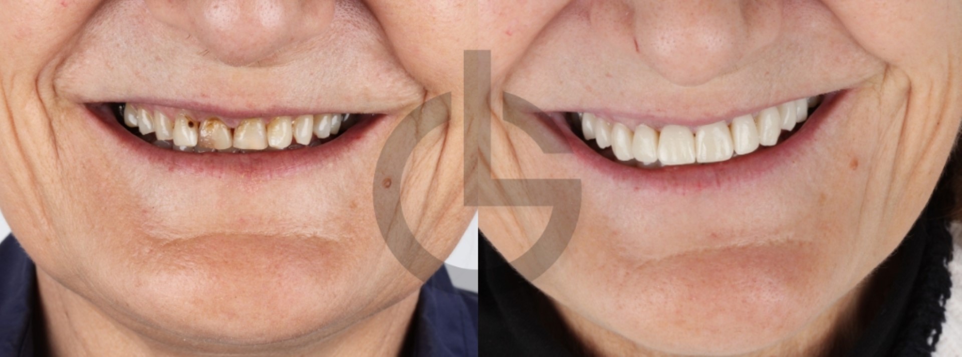 la estética dental no es solo una cuestión de imagen, sino también de confianza. Tu clínica de estética dental en Murcia